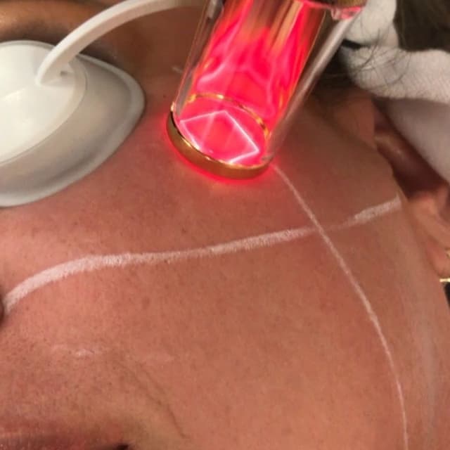RINOVARE FRAXEL LASER at Remake Beauty Studio Mcallen in McAllen, TX